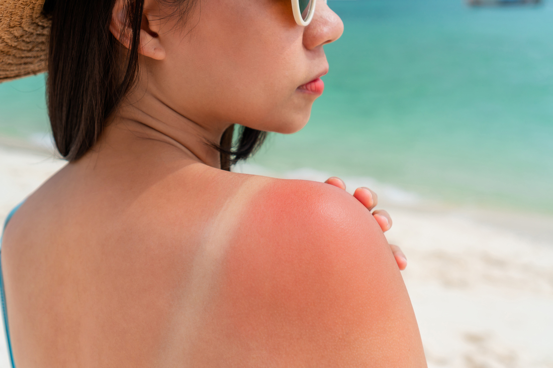 Sunburn on woman's shoulder.jpg