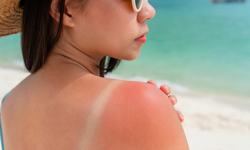 Sunburn on woman's shoulder.jpg