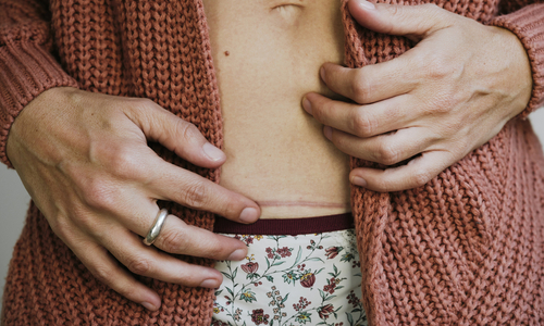 Woman with c-section scar.jpg