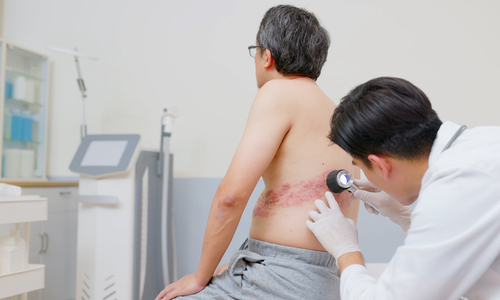 Doctor inspecting man's shingles.jpg