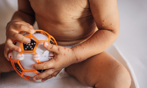 Hand foot mouth disease.jpg