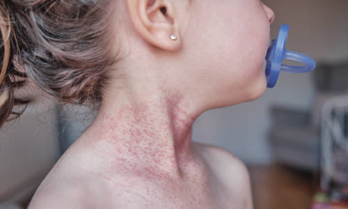 Child with rash on neck.jpg