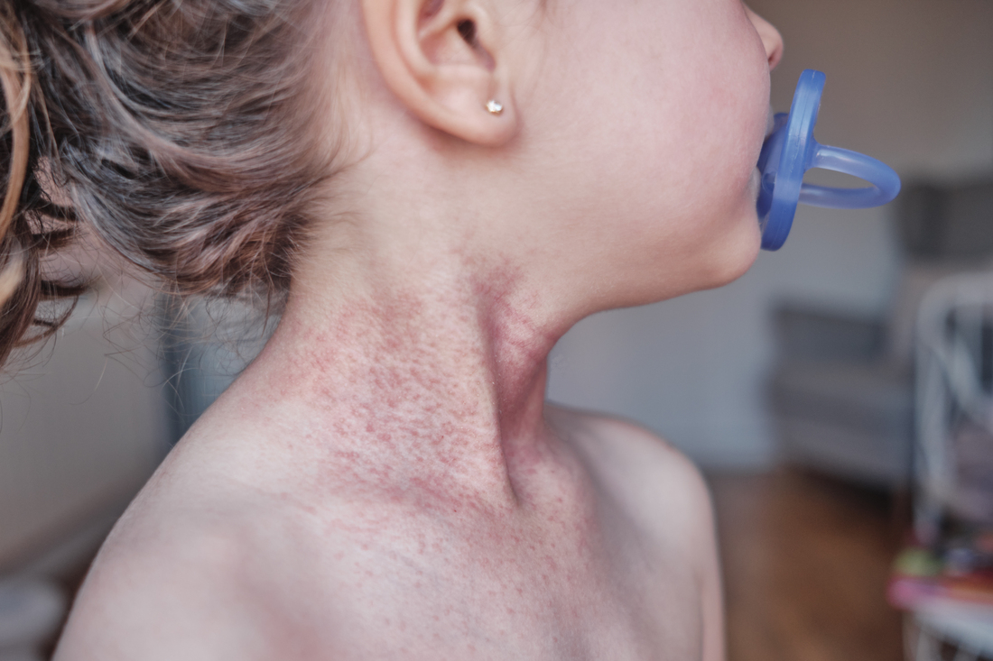 Child with rash on neck.jpg