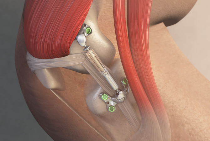 MISHA Knee System Implanted Shock Absorber Illustration