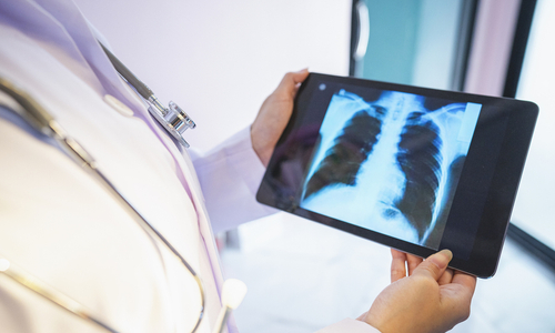 Doctor reviewing x-ray of lung tumor.jpg