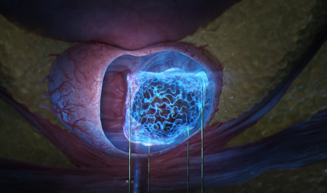 NanoKnife Prostate Electricity