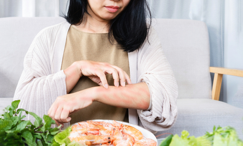 Woman scratching red arms in front of plate of sea food