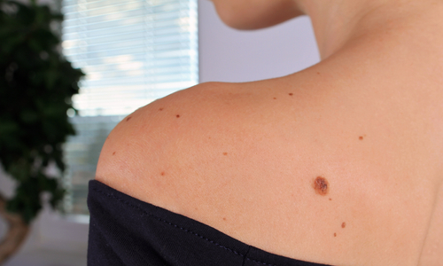 Skin mole on womans shoulder.jpg