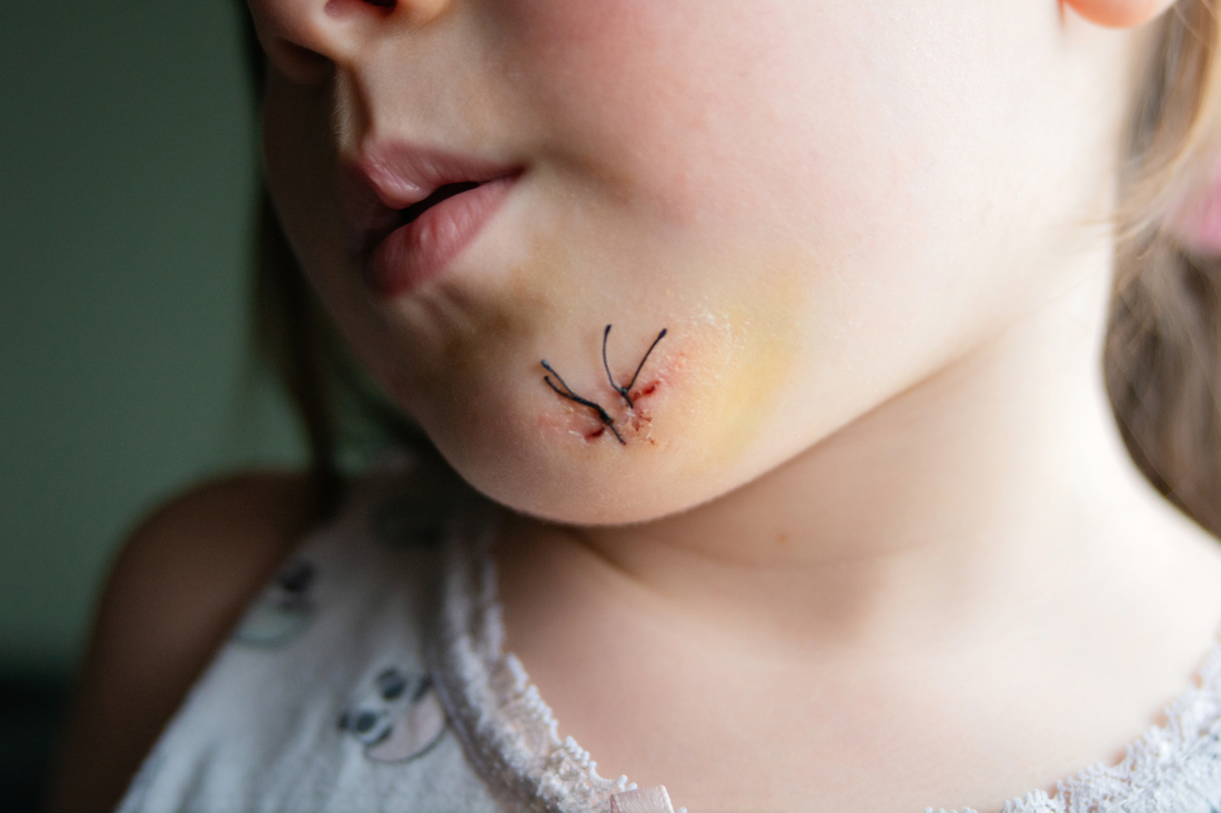 Stitches on child's chin wound.jpg