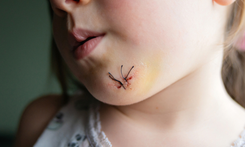 Stitches on child's chin wound.jpg